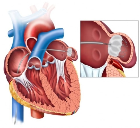 Portneuf Heart and Vascular Team Completes 100th Watchman